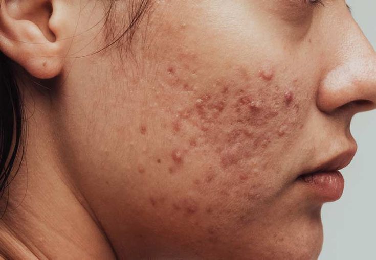 acne face map the cause of these breakouts