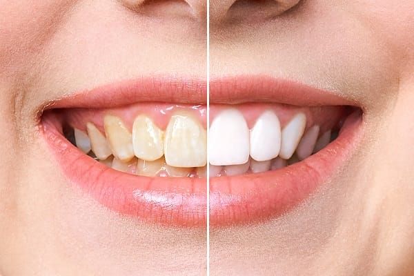 teeth whitening vs polishing which one is better dental veneers brighter image lab
