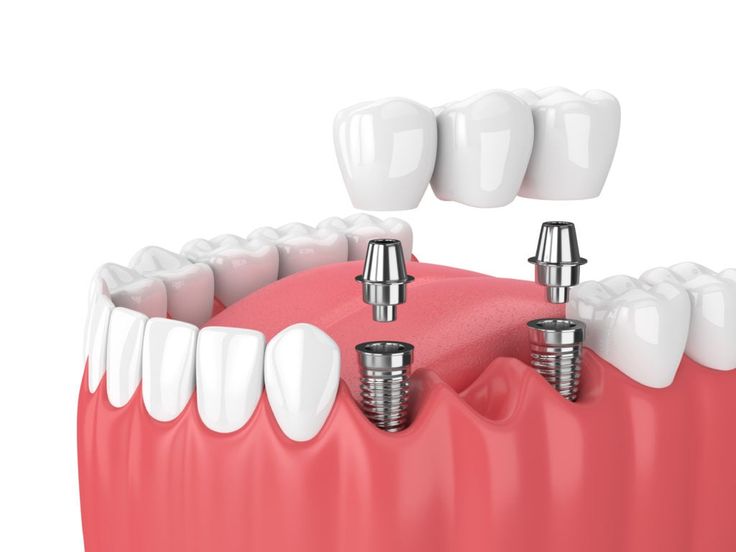 what is a dental bridge procedure, benefits, & cost